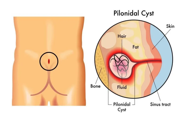 Is Pilonidal Sinus Dangerous
