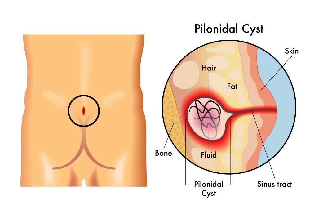 Is Pilonidal Sinus Dangerous